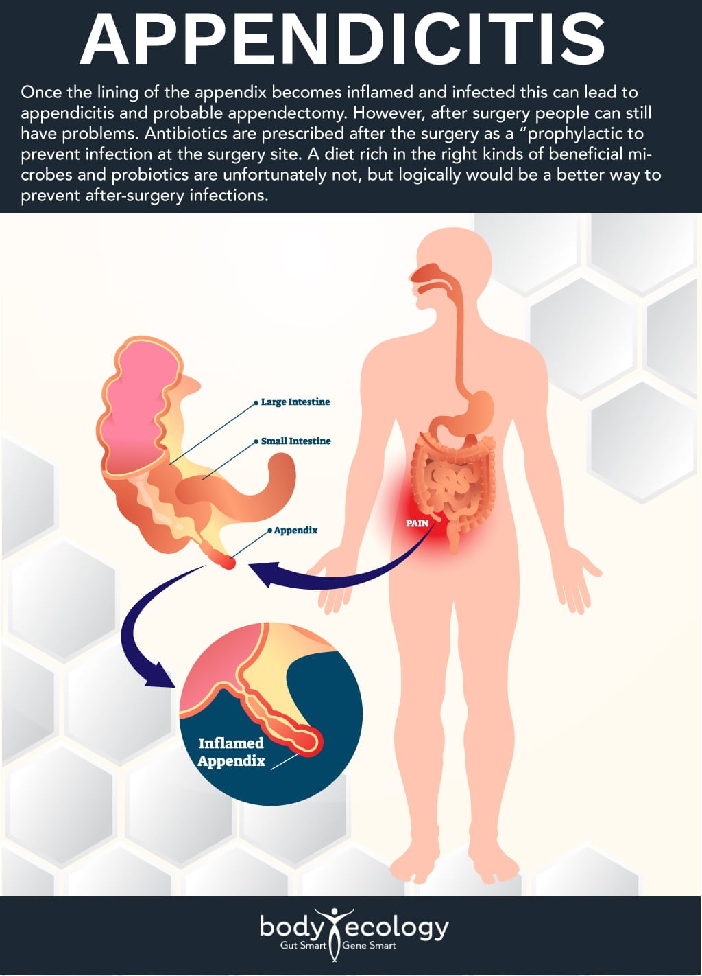 The Appendix: Not a Useless Organ | Body Ecology